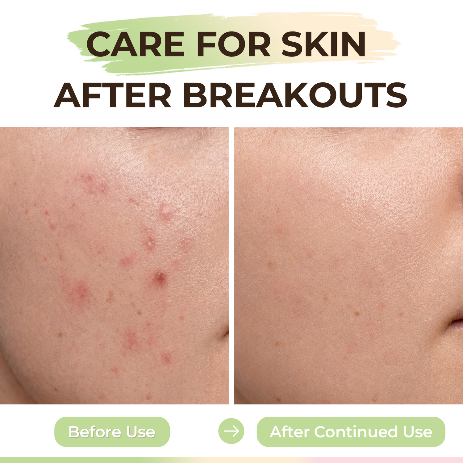 Microdart Dark Spot Patches for Post-Blemish Marks