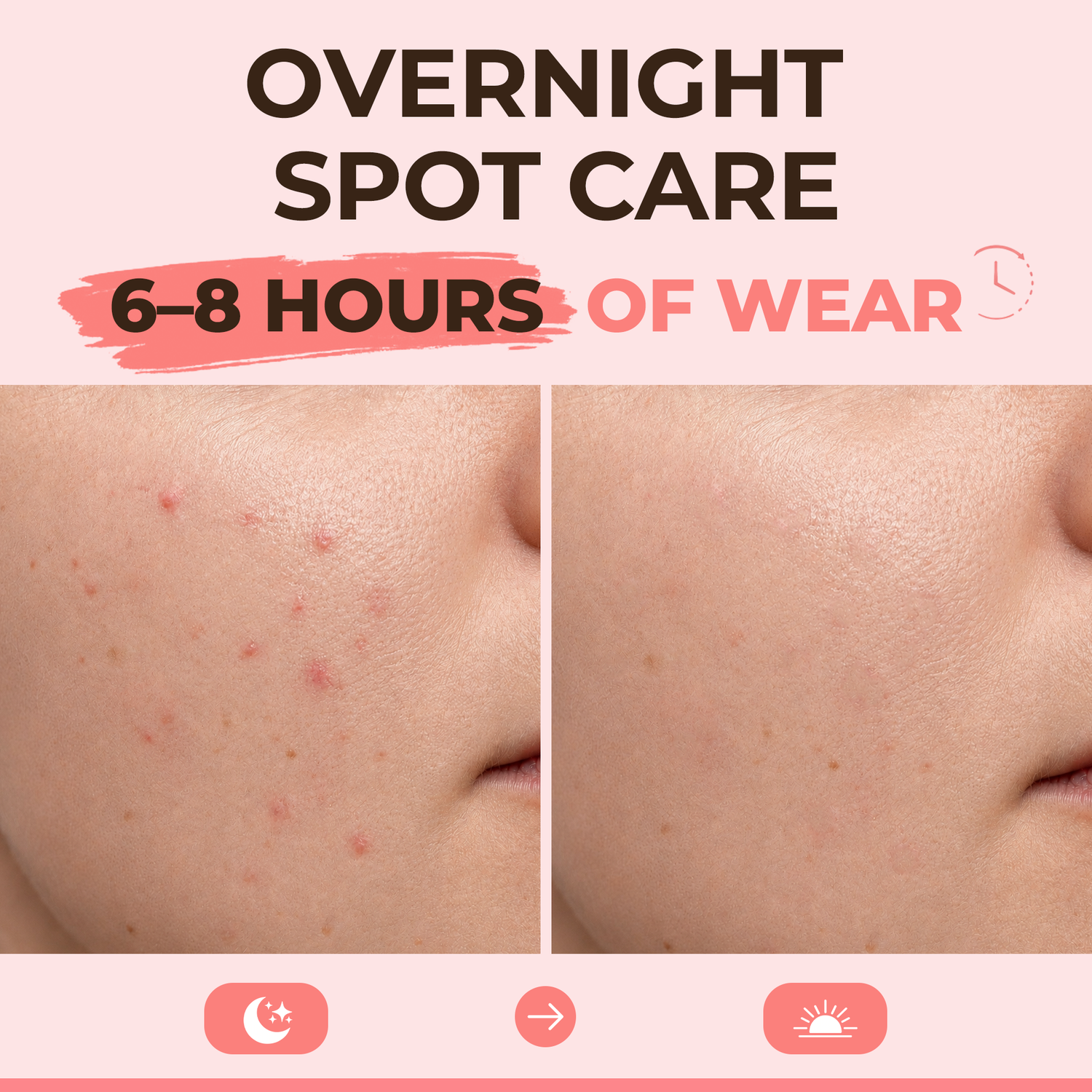 Microdart Acne Patches for Early-Stage Blemishes