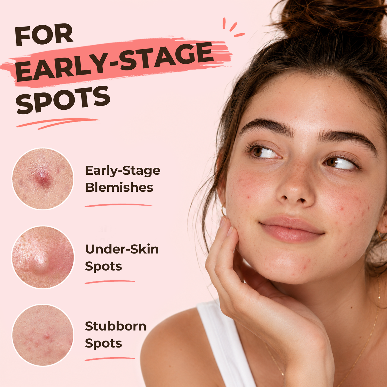 Microdart Acne Patches for Early-Stage Blemishes